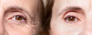 אישה מבוגרת לפני ואחרי טיפול שקעי עיניים ללא קמטים