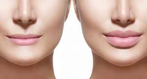 תמונה של שפתיים של אישה לפני ואחרי תהליך עיבוי שפתיים
