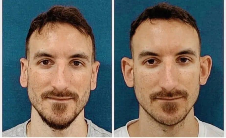 תמונה לפני ואחרי של בחור שעשה ניתוח להצמדת אוזניים