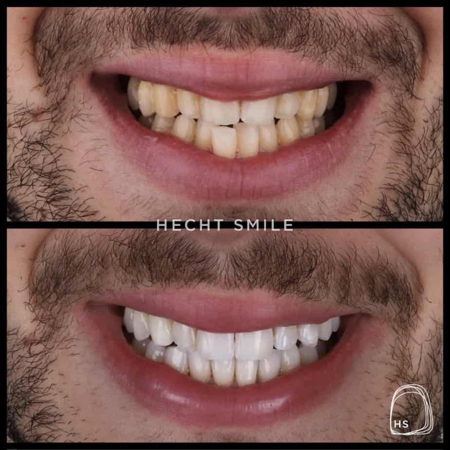לפני ואחרי - חיוך של בחורה עם ובלי שיניים עקומות ולבנות