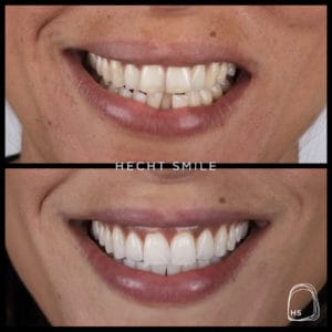 יישור שיניים בשיטת Invisalign