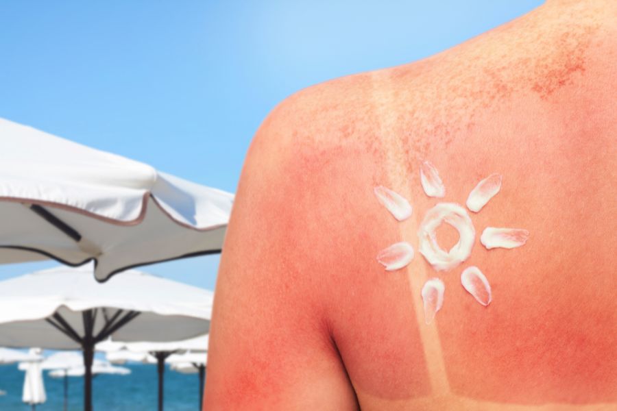 השפעת השמש הישראלית על בריאות העור